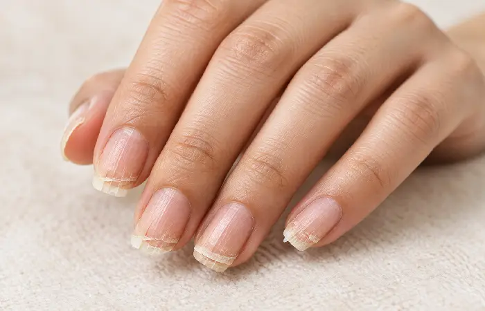 brittle nails